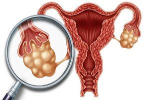 Ung Thu Buong Trung 1637986503204832880367